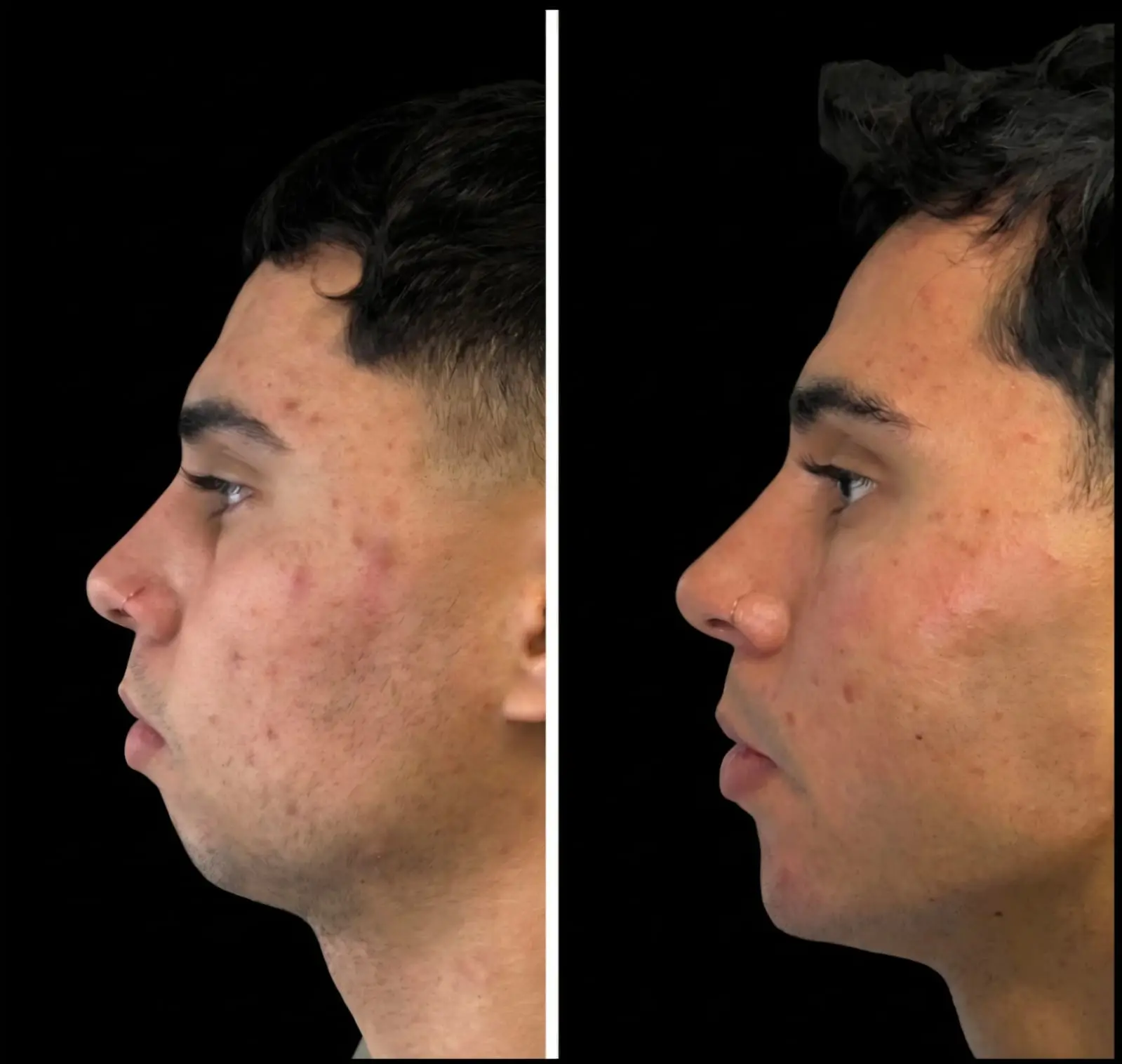Resultado de bioestimulación facial masculina - Bioestimulación
